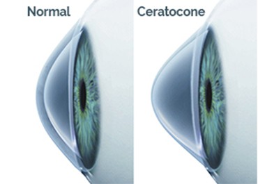 Ceratocone